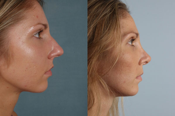 before and after rhinoplasty female patient right side view case 3662