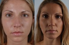 before and after rhinoplasty female patient front view case 3662