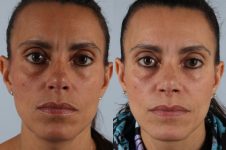 before and after rhinoplasty female patient front view case 3665