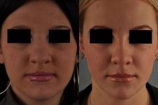 before and after rhinoplasty female patient front view case 3670