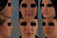 before and after rhinoplasty female patient multiple angle view case 3670