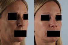 before and after rhinoplasty female patient right diagonal view case 3673