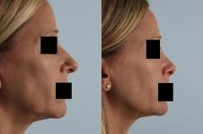 before and after rhinoplasty female patient right side view case 3673