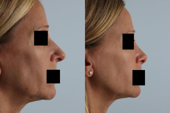 before and after rhinoplasty female patient right side view case 3673