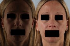 before and after rhinoplasty female patient front view case 3673