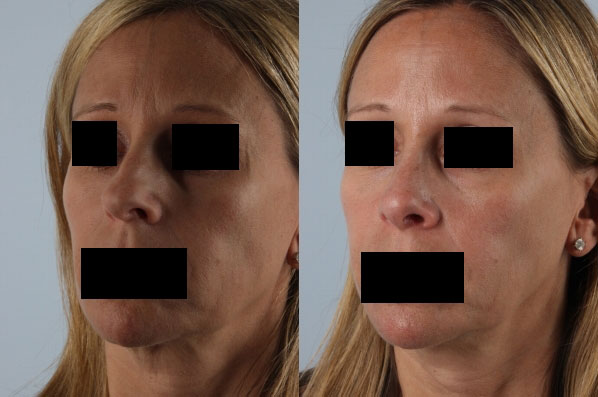 before and after rhinoplasty female patient left diagonal view case 3673