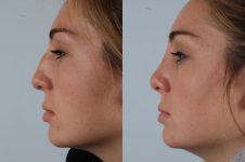 before and after rhinoplasty female patient left side view case 3678