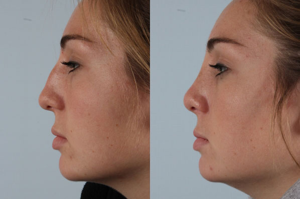 before and after rhinoplasty female patient left side view case 3678