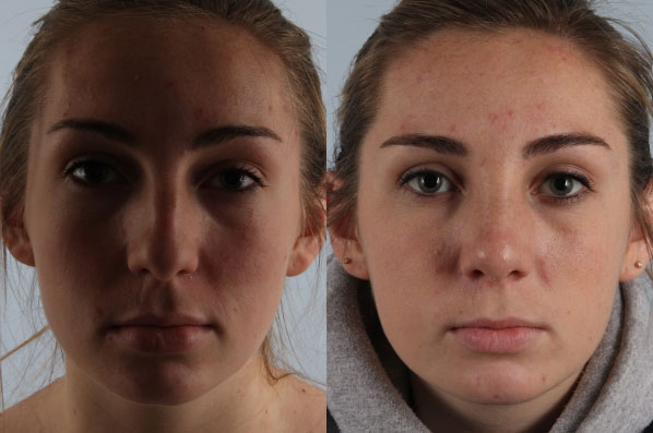 before and after rhinoplasty female patient front view case 3678