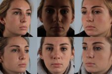 before and after rhinoplasty female patient multiple angle view case 3678