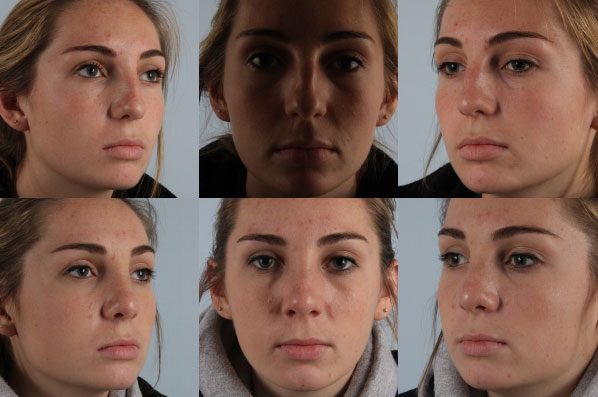 before and after rhinoplasty female patient multiple angle view case 3678