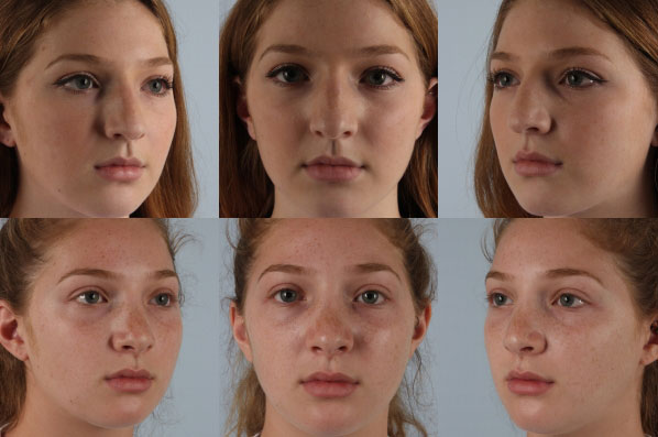 before and after rhinoplasty female patient multiple angle view case 3682