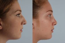 before and after rhinoplasty female patient right side view case 3682