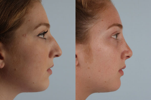 before and after rhinoplasty female patient right side view case 3682