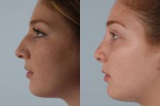 before and after rhinoplasty female patient left side view case 3682