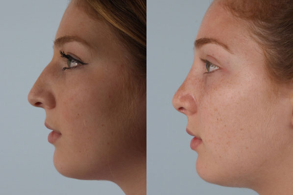 before and after rhinoplasty female patient left side view case 3682
