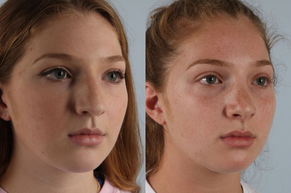 before and after rhinoplasty female patient right diagonal view case 3682