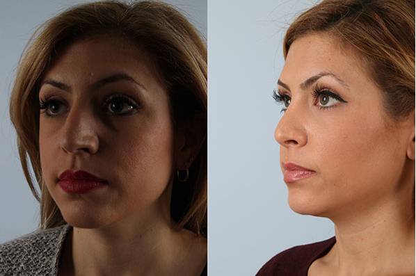 before and after rhinoplasty female patient left diagonal view case 3687
