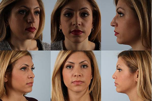 before and after rhinoplasty female patient multiple angle view case 3687