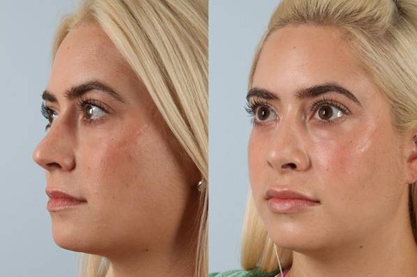 before and after rhinoplasty female patient left diagonal view case 3692