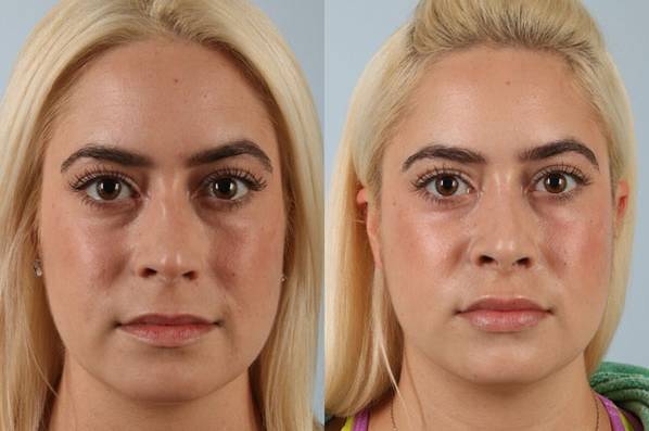 before and after rhinoplasty female patient front view case 3692