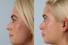 before and after rhinoplasty female patient left side view case 3692