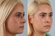 before and after rhinoplasty female patient right diagonal view case 3692
