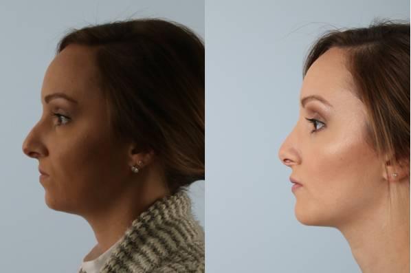 before and after rhinoplasty female patient left side view case 3697