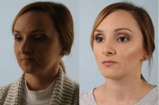 before and after rhinoplasty female patient left diagonal view case 3697