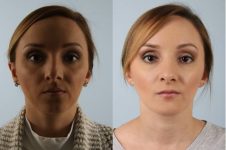 before and after rhinoplasty female patient front view case 3697