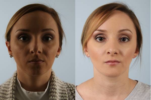 before and after rhinoplasty female patient front view case 3697