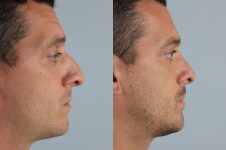 before and after rhinoplasty male patient right side view case 3702