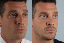 before and after rhinoplasty male patient right diagonal view case 3702