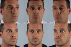 before and after rhinoplasty male patient multiple angle view case 3702