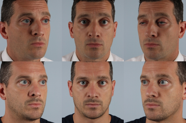 before and after rhinoplasty male patient multiple angle view case 3702