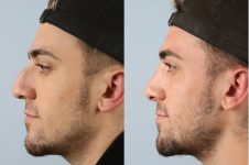 before and after rhinoplasty male patient left side view case 3706