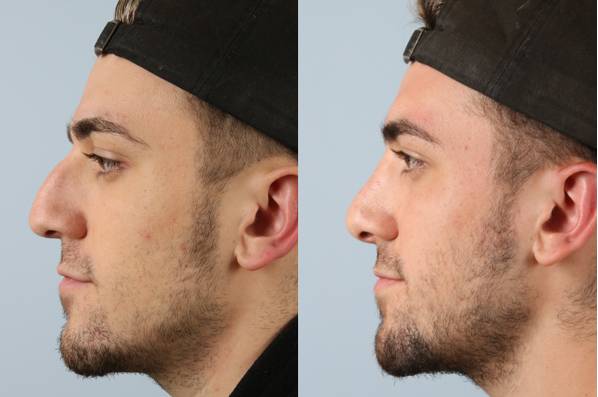 before and after rhinoplasty male patient left side view case 3706