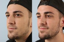 before and after rhinoplasty male patient left diagonal view case 3706