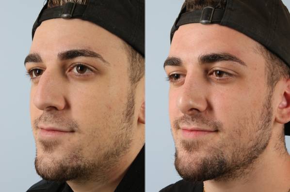 before and after rhinoplasty male patient left diagonal view case 3706