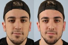 before and after rhinoplasty male patient front view case 3706
