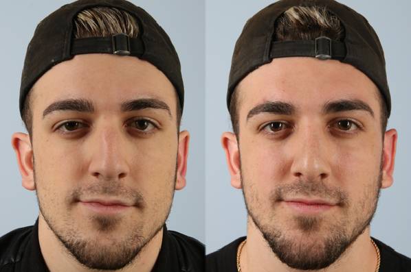 before and after rhinoplasty male patient front view case 3706