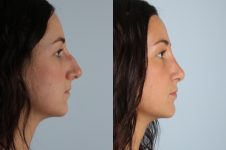 before and after rhinoplasty female patient right side view case 3710