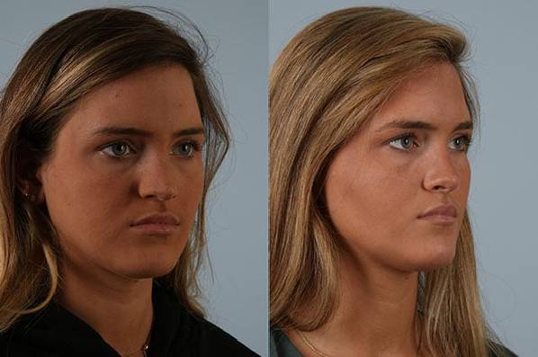 before and after rhinoplasty female patient right diagonal view case 3715