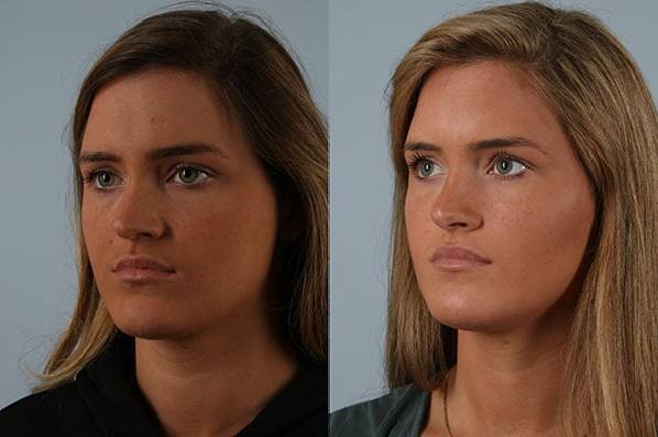 before and after rhinoplasty female patient left diagonal view case 3715