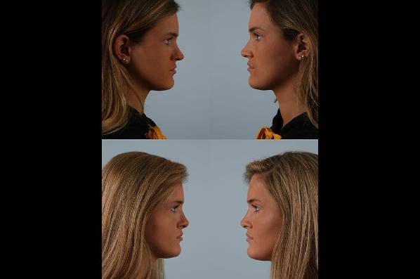before and after rhinoplasty female patient left and right side view case 3715