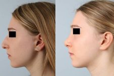 before and after rhinoplasty female patient left side view case 3720