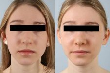 before and after rhinoplasty female patient front view case 3720