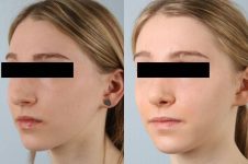 before and after rhinoplasty female patient left diagonal view case 3720