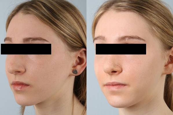before and after rhinoplasty female patient left diagonal view case 3720