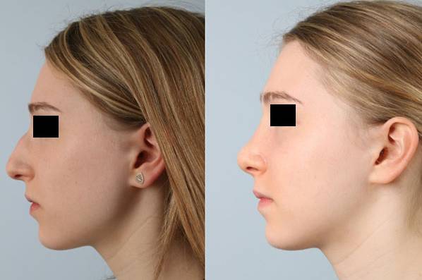 before and after rhinoplasty female patient left side view case 3720